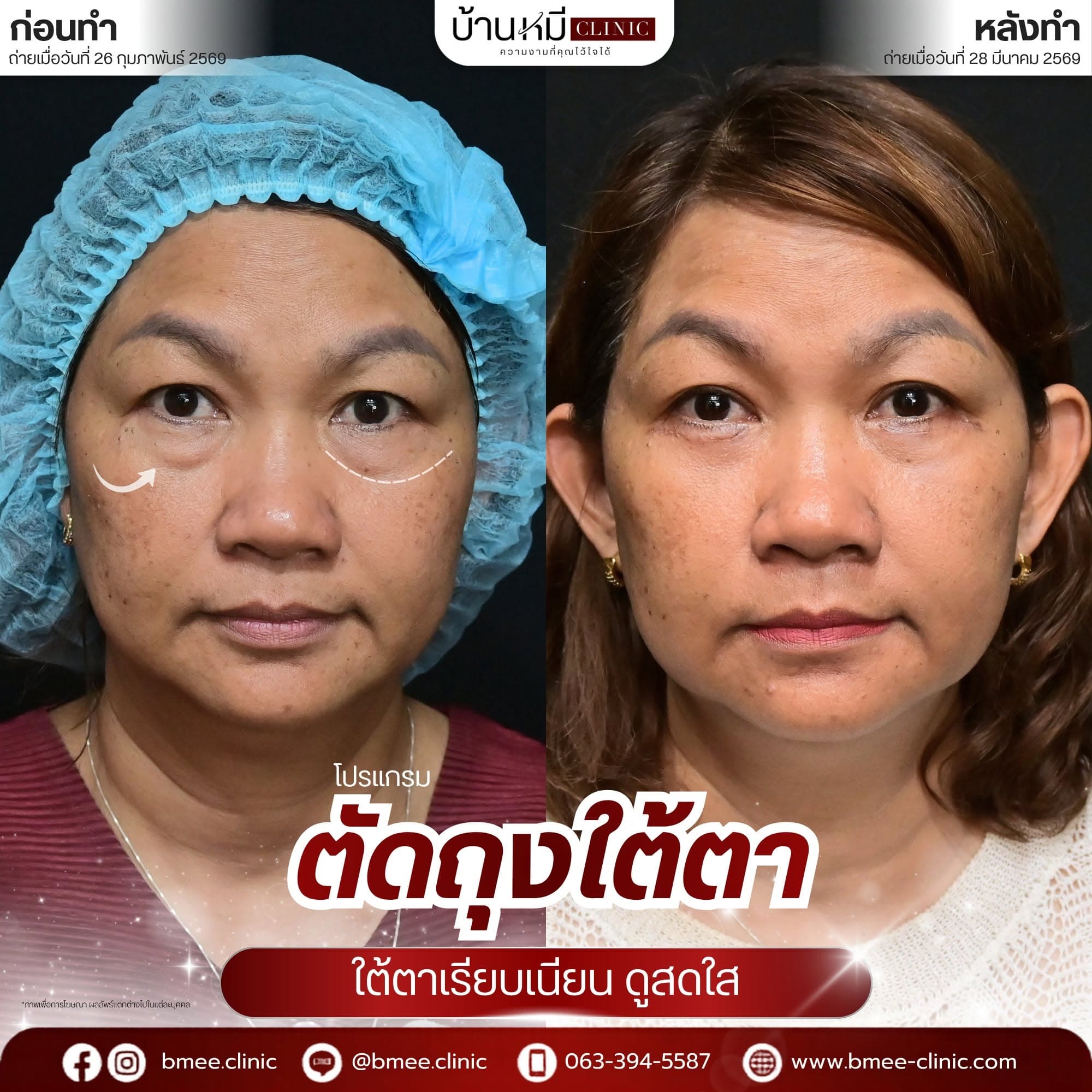 รีวิวเคสตัดถุงใต้ตา บ้านหมี คลินิก