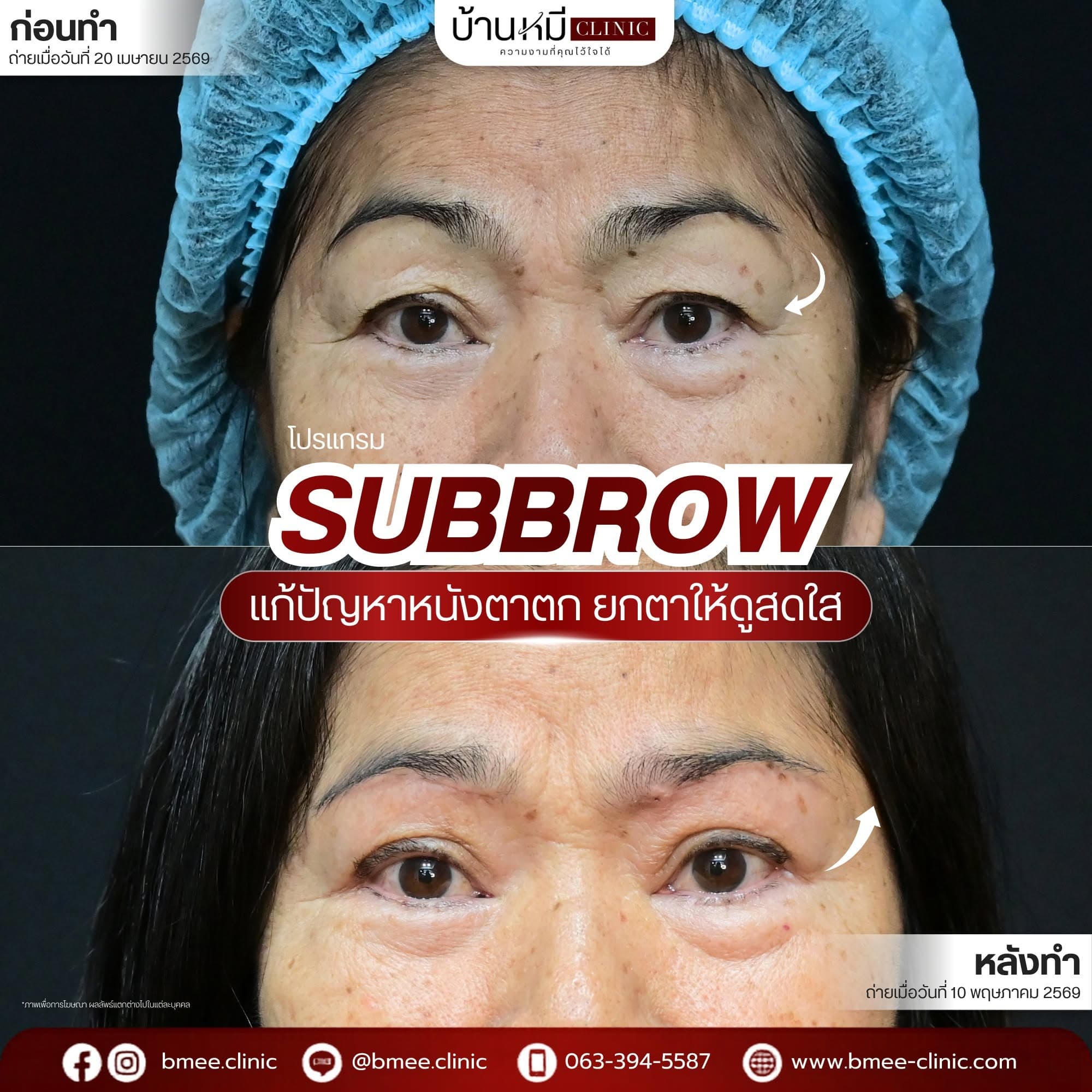 รีวิวเคส Subbrow ยกหนังตาตก บ้านหมี คลินิก
