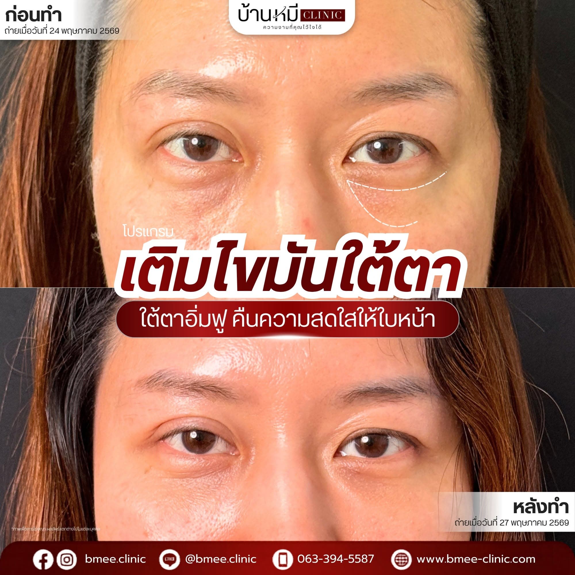 รีวิวเคสเติมไขมันใต้ตา บ้านหมี คลินิก