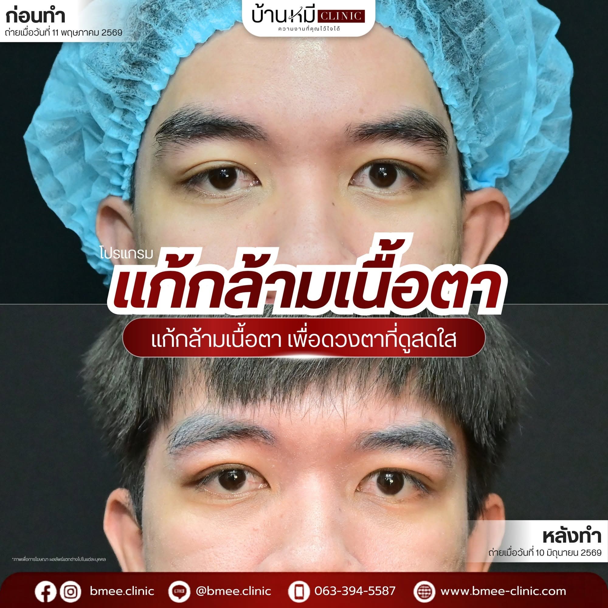 รีวิวเคสแก้กล้ามเนื้อตา (ตาปรือ) บ้านหมี คลินิก