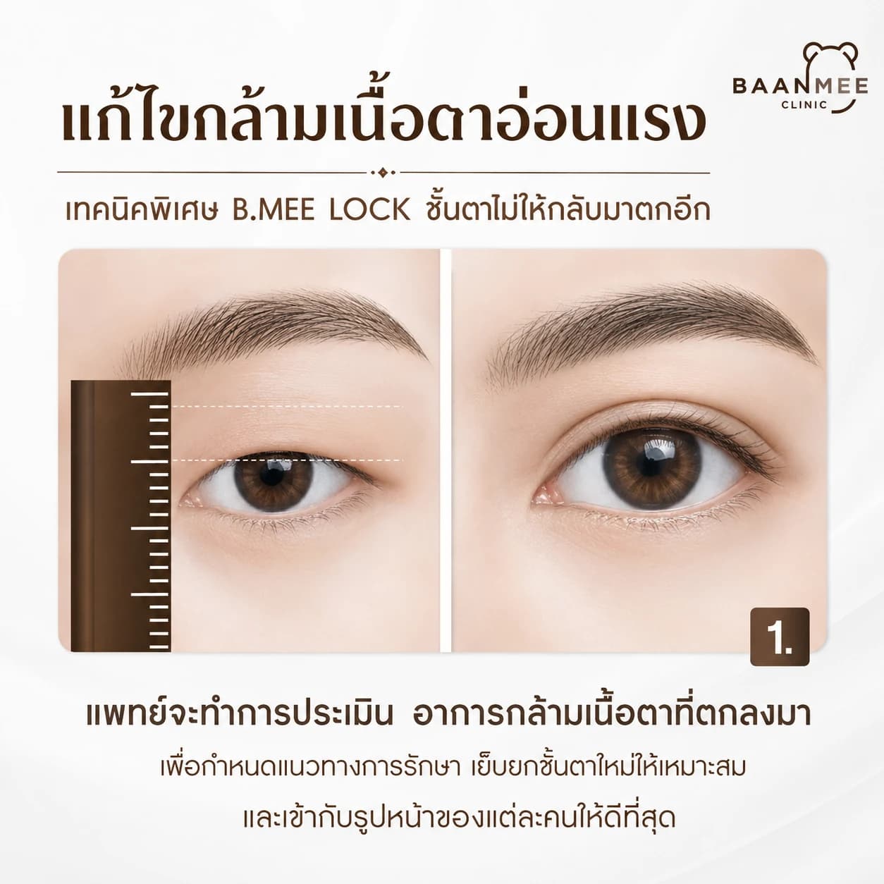 ขั้นตอนประเมินอาการกล้ามเนื้อตาอ่อนแรง