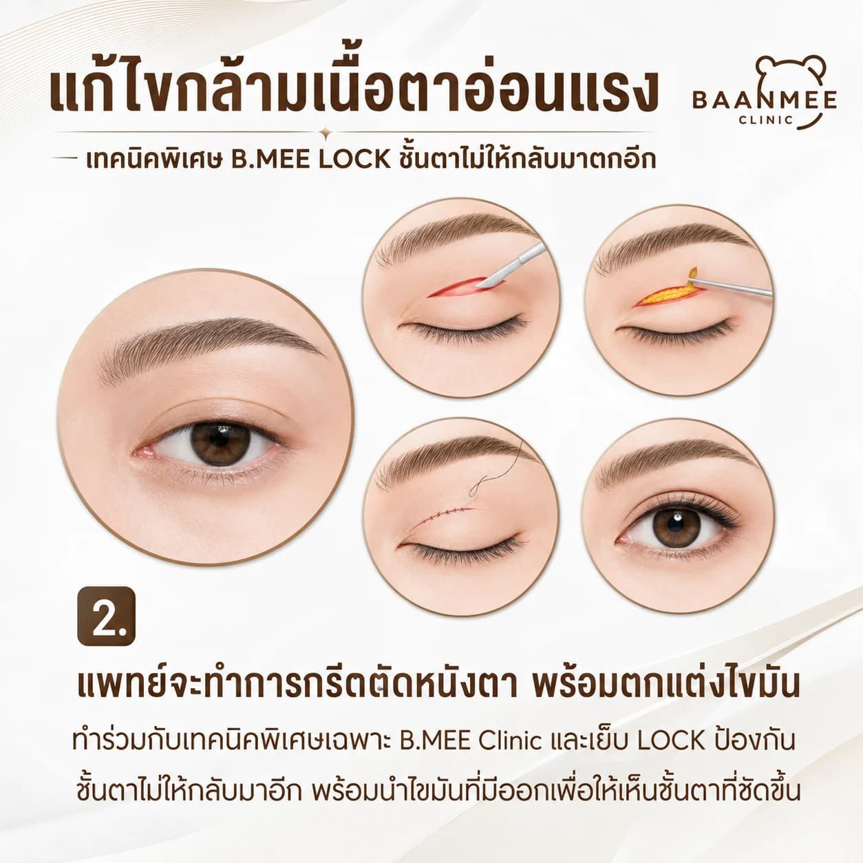 ขั้นตอนผ่าตัดแก้ไขกล้ามเนื้อตาอ่อนแรง