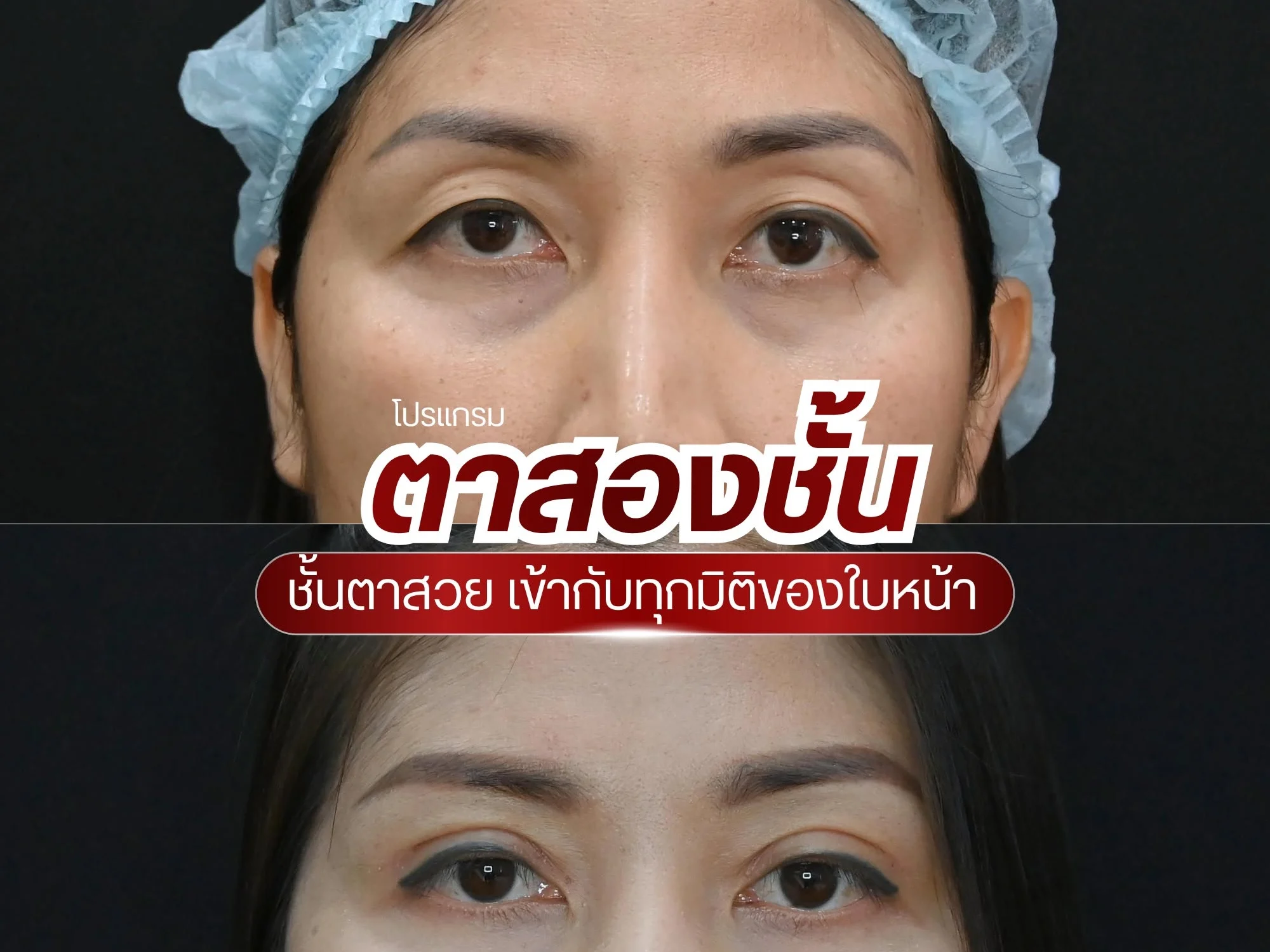 ศัลยกรรมตาสองชั้น บ้านหมีคลินิก