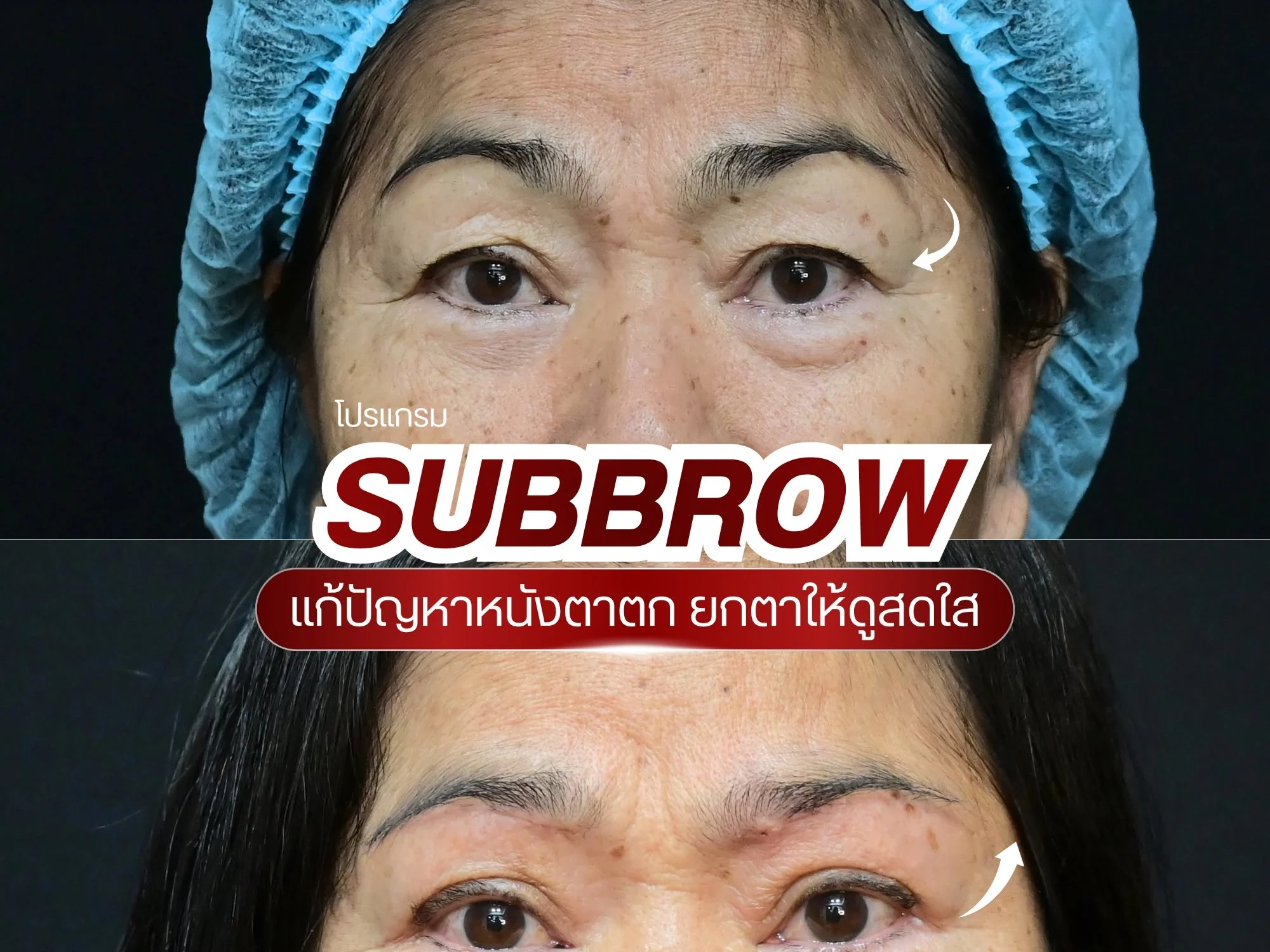 ศัลยกรรมหนังตาตก บ้านหมีคลินิก