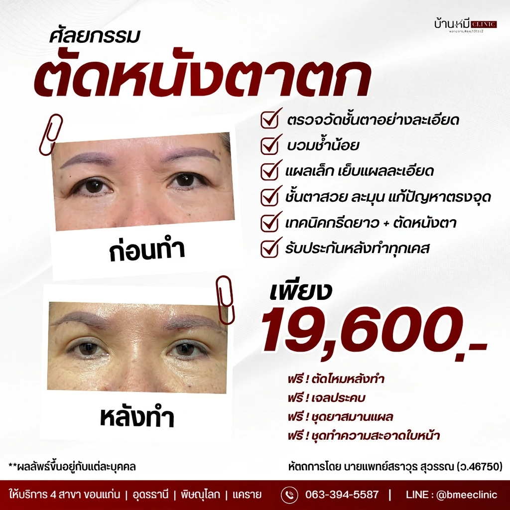 โปรโมชั่นศัลยกรรมตัดหนังตาตก ราคาพิเศษ 19,600 บาท บ้านหมี คลินิก