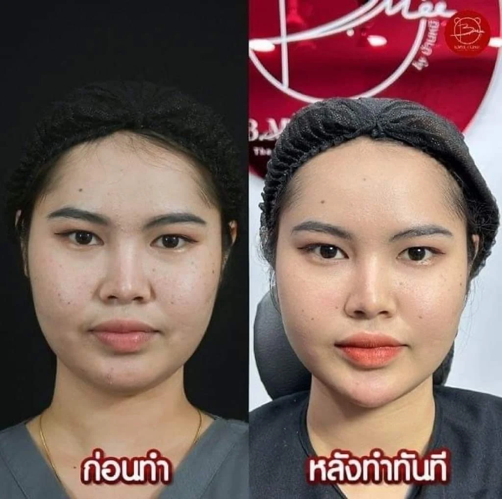 รีวิวฟิลเลอร์คาง บ้านหมี คลินิก