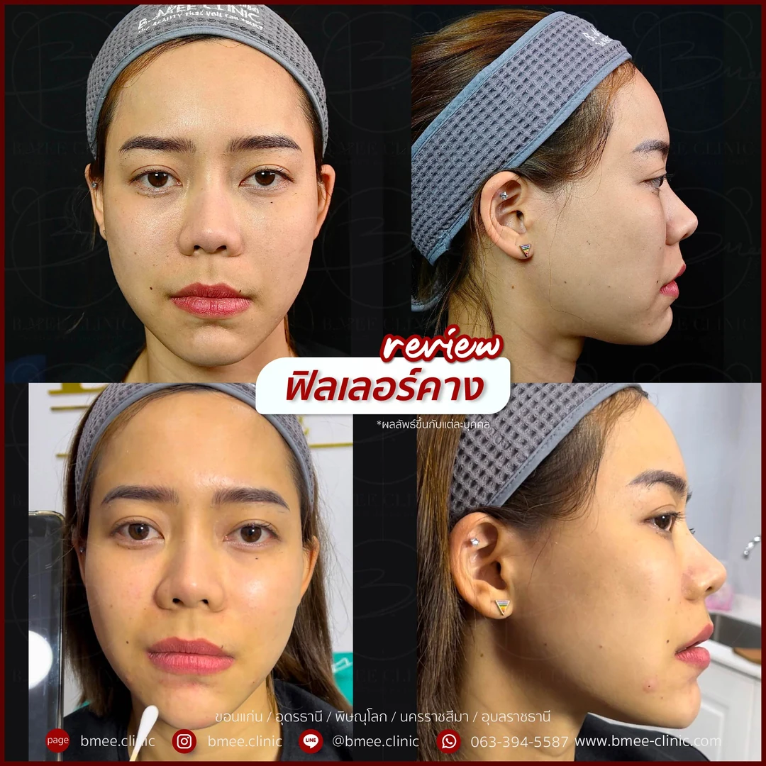 รีวิวฟิลเลอร์คาง บ้านหมี คลินิก