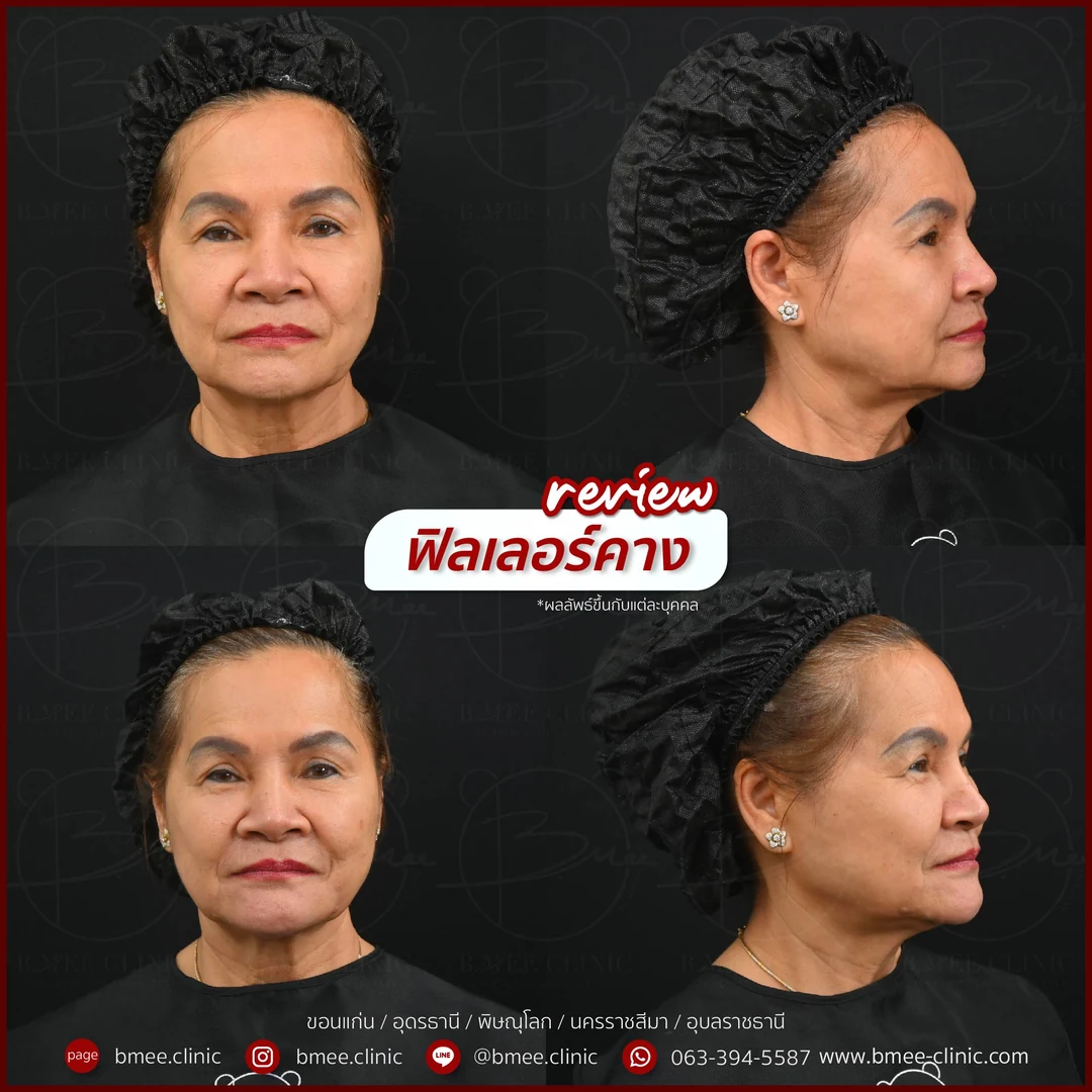 รีวิวฟิลเลอร์คาง บ้านหมี คลินิก