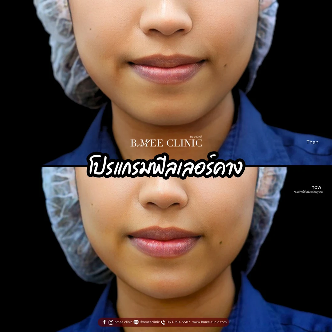รีวิวฟิลเลอร์คาง บ้านหมี คลินิก