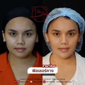 รีวิวฟิลเลอร์คาง บ้านหมี คลินิก