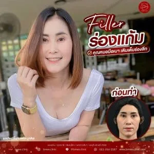รีวิวฟิลเลอร์คาง บ้านหมี คลินิก
