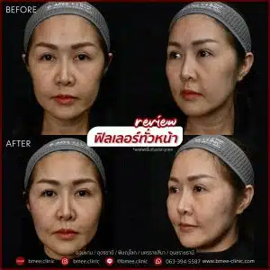 รีวิวฟิลเลอร์ปรับรูปหน้า บ้านหมี คลินิก