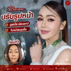 รีวิวฟิลเลอร์ปรับรูปหน้า บ้านหมี คลินิก