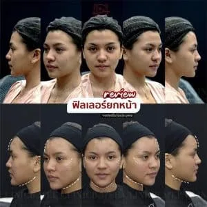 รีวิวฟิลเลอร์ปรับรูปหน้า บ้านหมี คลินิก