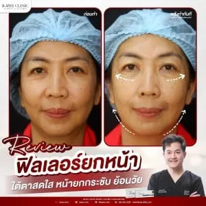 รีวิวฟิลเลอร์ปรับรูปหน้า บ้านหมี คลินิก
