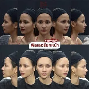 รีวิวฟิลเลอร์ปรับรูปหน้า บ้านหมี คลินิก