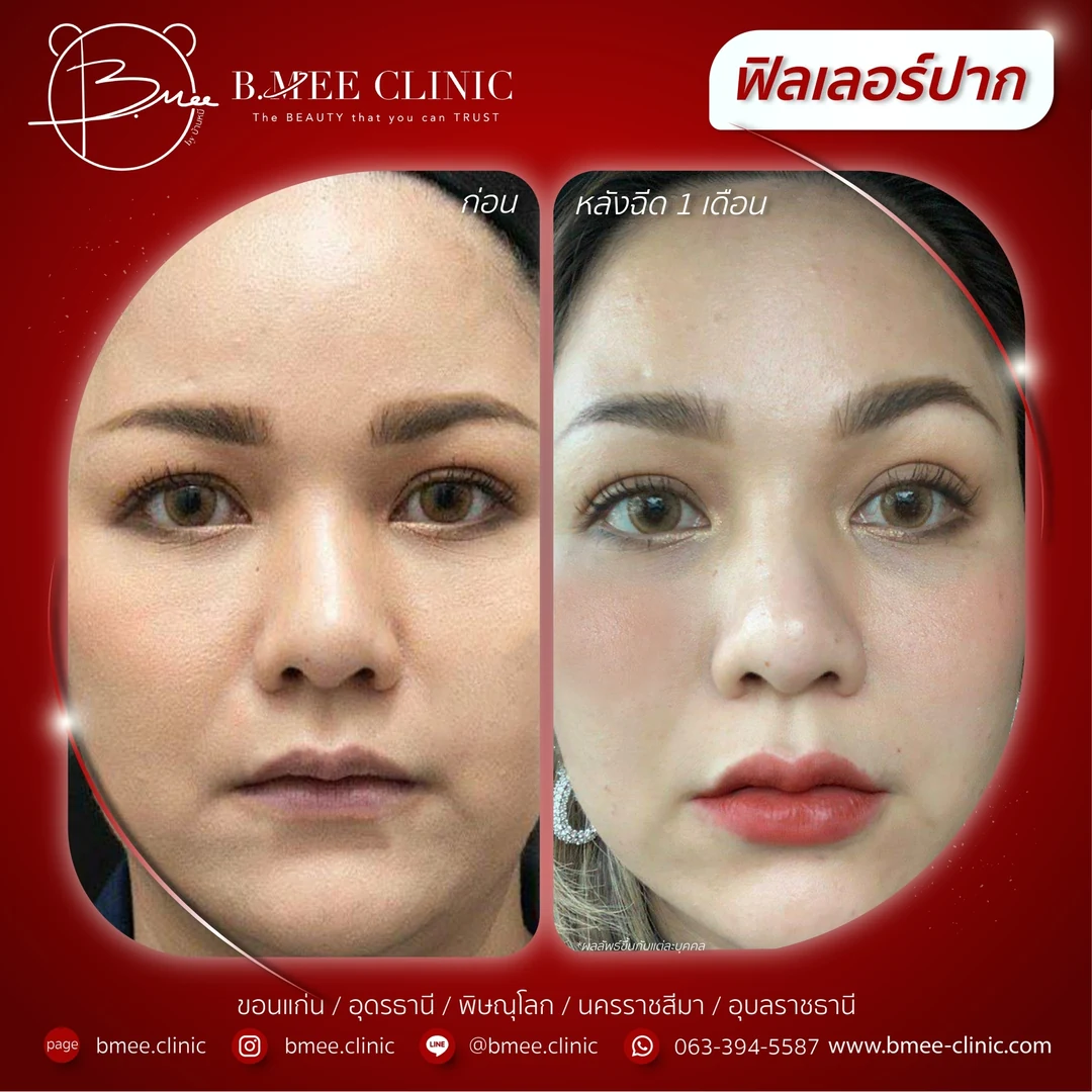 รีวิวฟิลเลอร์ปาก บ้านหมี คลินิก