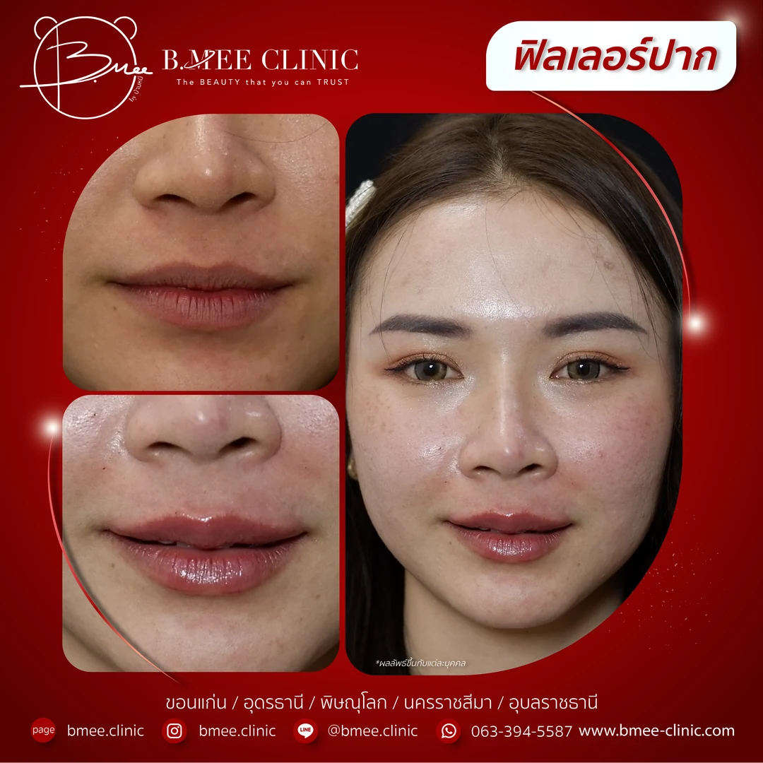 รีวิวฟิลเลอร์ปาก บ้านหมี คลินิก