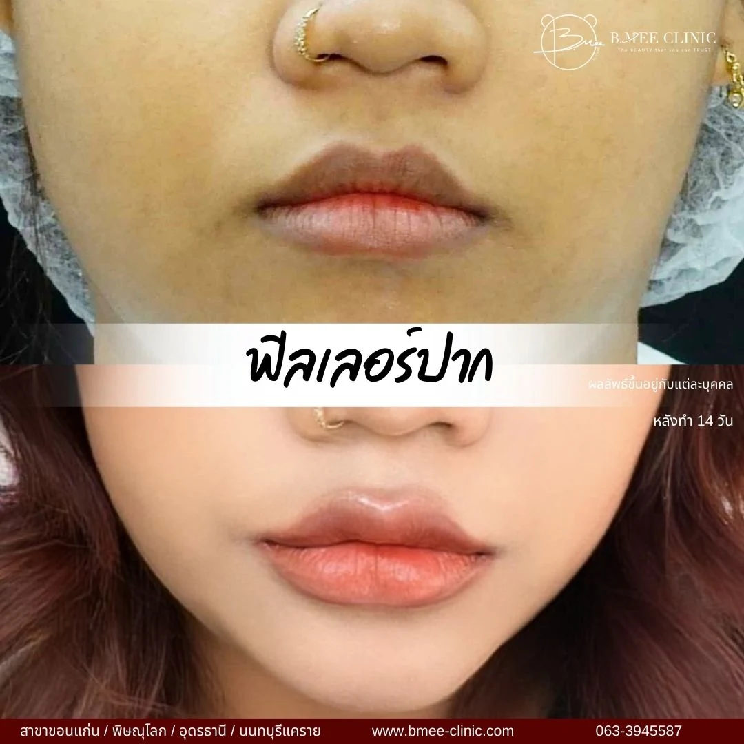 รีวิวฟิลเลอร์ปาก บ้านหมี คลินิก