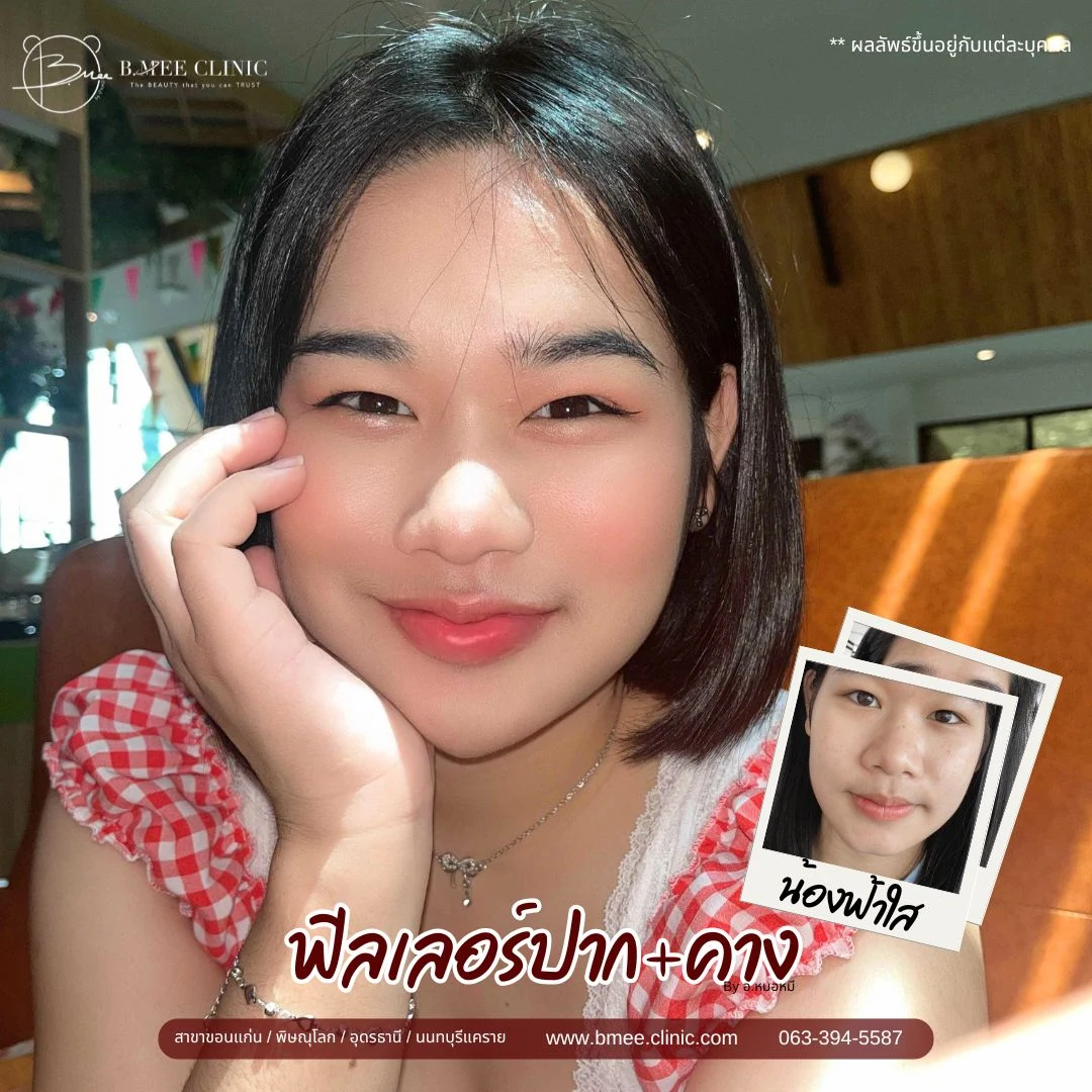 รีวิวฟิลเลอร์ปาก บ้านหมี คลินิก