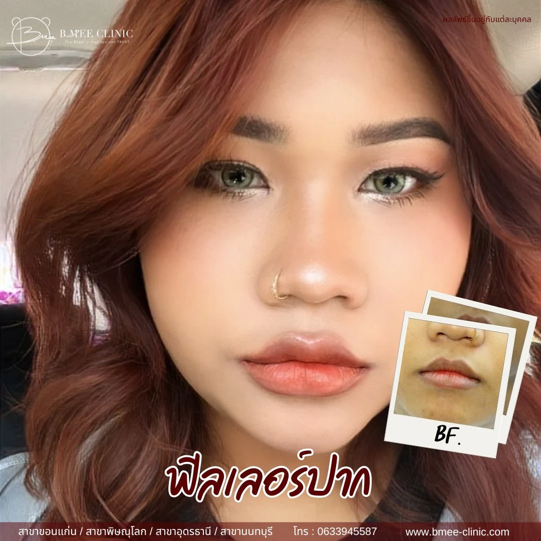 รีวิวฟิลเลอร์ปาก บ้านหมี คลินิก