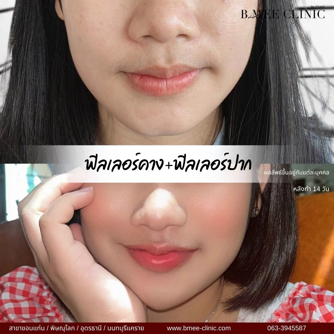 รีวิวฟิลเลอร์ปาก บ้านหมี คลินิก