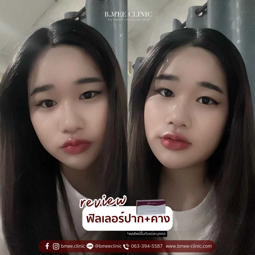 รีวิวฟิลเลอร์ปาก บ้านหมี คลินิก