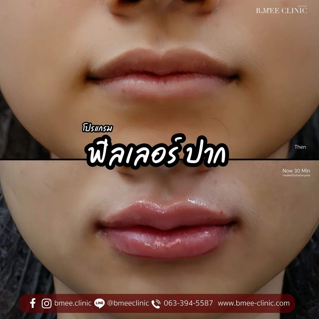 รีวิวฟิลเลอร์ปาก บ้านหมี คลินิก