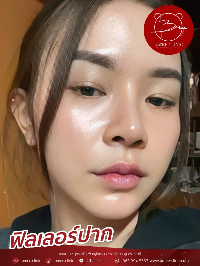 รีวิวฟิลเลอร์ปาก บ้านหมี คลินิก