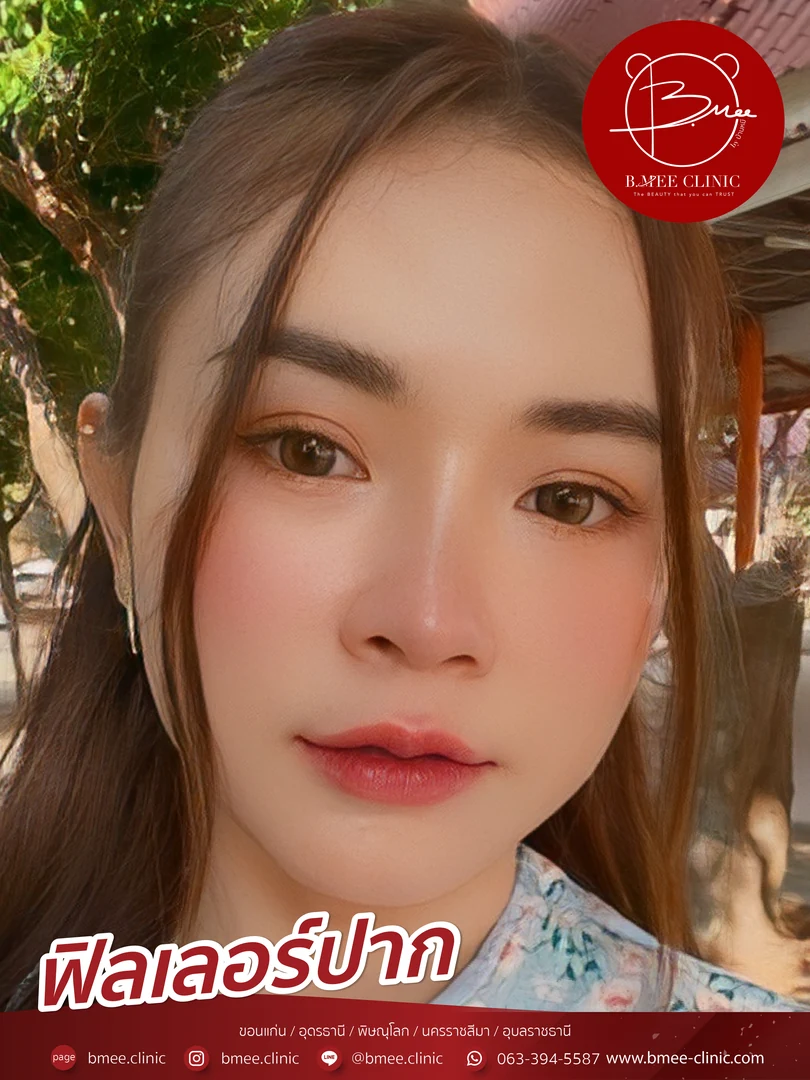 รีวิวฟิลเลอร์ปาก บ้านหมี คลินิก