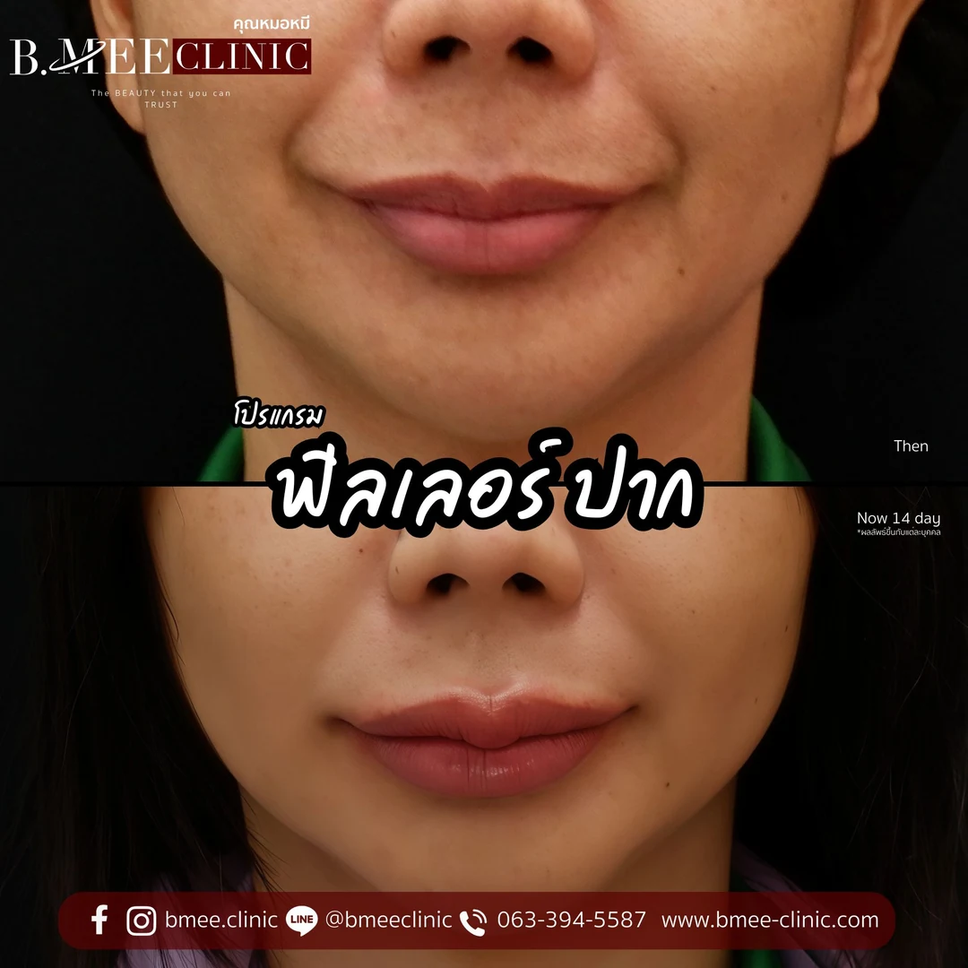 รีวิวฟิลเลอร์ปาก บ้านหมี คลินิก