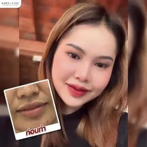 รีวิวฟิลเลอร์ปาก บ้านหมี คลินิก
