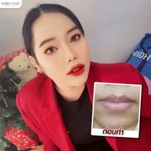 รีวิวฟิลเลอร์ปาก บ้านหมี คลินิก
