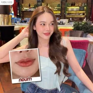 รีวิวฟิลเลอร์ปาก บ้านหมี คลินิก