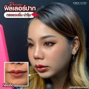 รีวิวฟิลเลอร์ปาก บ้านหมี คลินิก