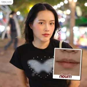 รีวิวฟิลเลอร์ปาก บ้านหมี คลินิก