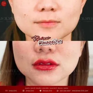 รีวิวฟิลเลอร์ปาก บ้านหมี คลินิก