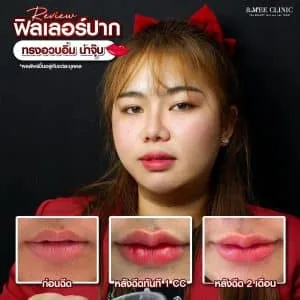 รีวิวฟิลเลอร์ปาก บ้านหมี คลินิก