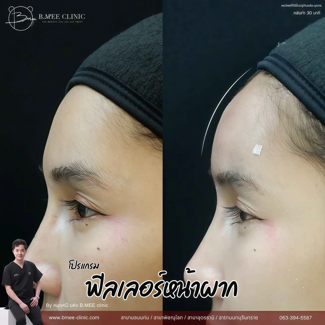 รีวิวฟิลเลอร์หน้าผาก บ้านหมี คลินิก