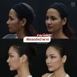 รีวิวฟิลเลอร์หน้าผาก บ้านหมี คลินิก