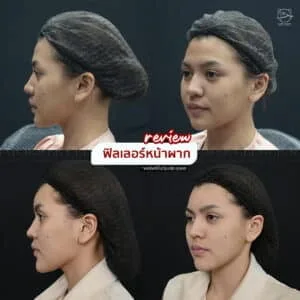 รีวิวฟิลเลอร์หน้าผาก บ้านหมี คลินิก