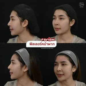 รีวิวฟิลเลอร์หน้าผาก บ้านหมี คลินิก