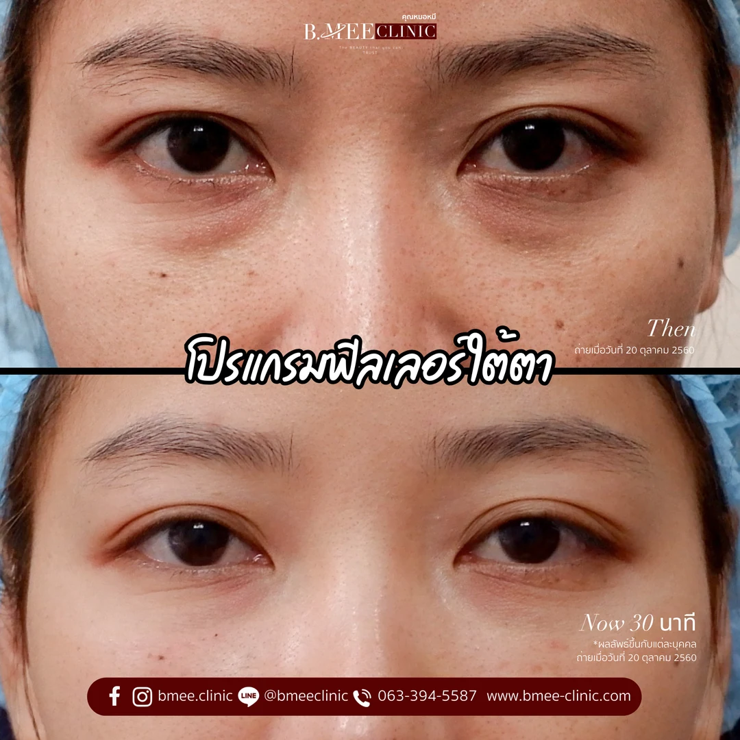 รีวิวฟิลเลอร์ใต้ตา บ้านหมี คลินิก