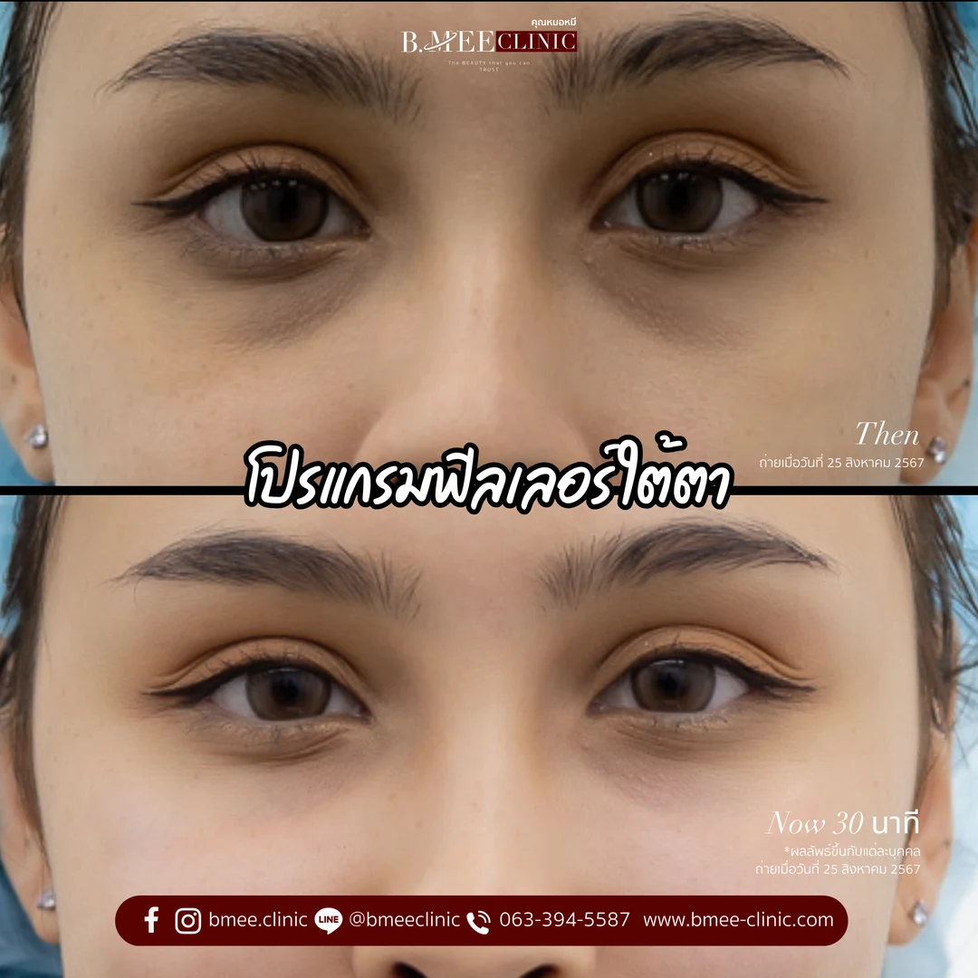 รีวิวฟิลเลอร์ใต้ตา บ้านหมี คลินิก
