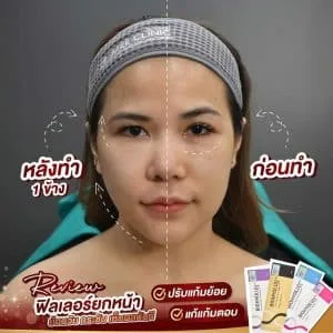 รีวิวฟิลเลอร์ใต้ตา บ้านหมี คลินิก
