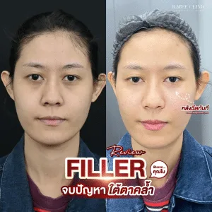รีวิวฟิลเลอร์ใต้ตา บ้านหมี คลินิก