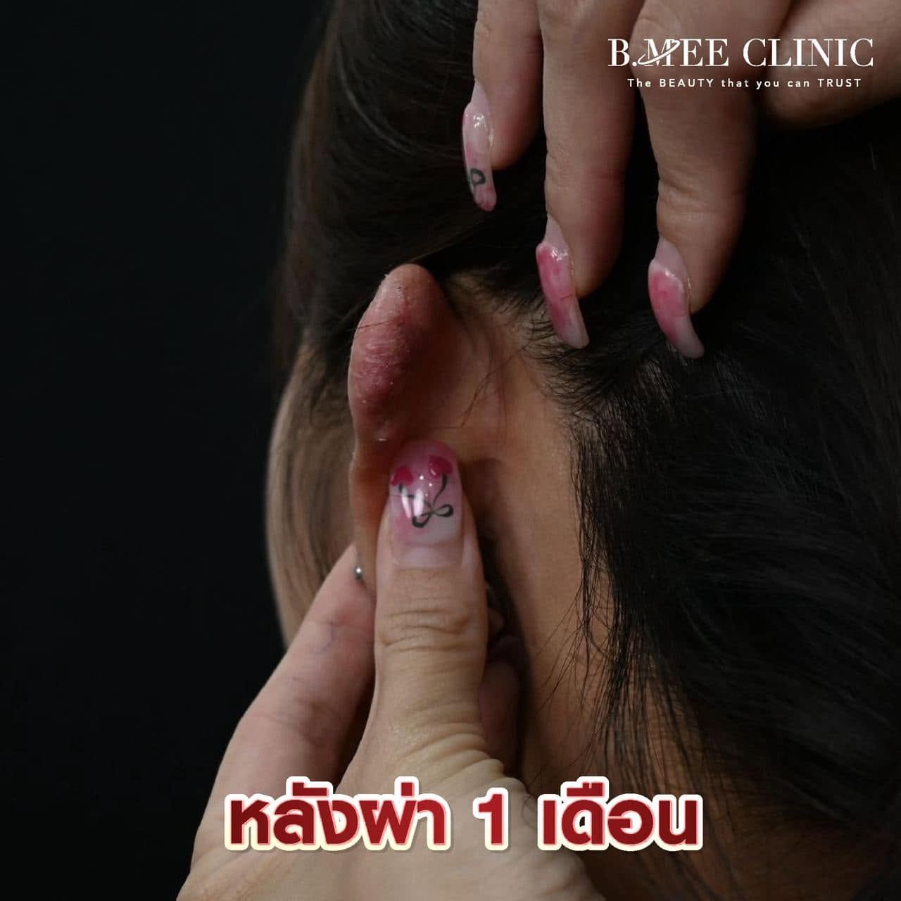 รีวิวผลการรักษาคีลอยด์ หลังทำ 1 เดือน บ้านหมี คลินิก