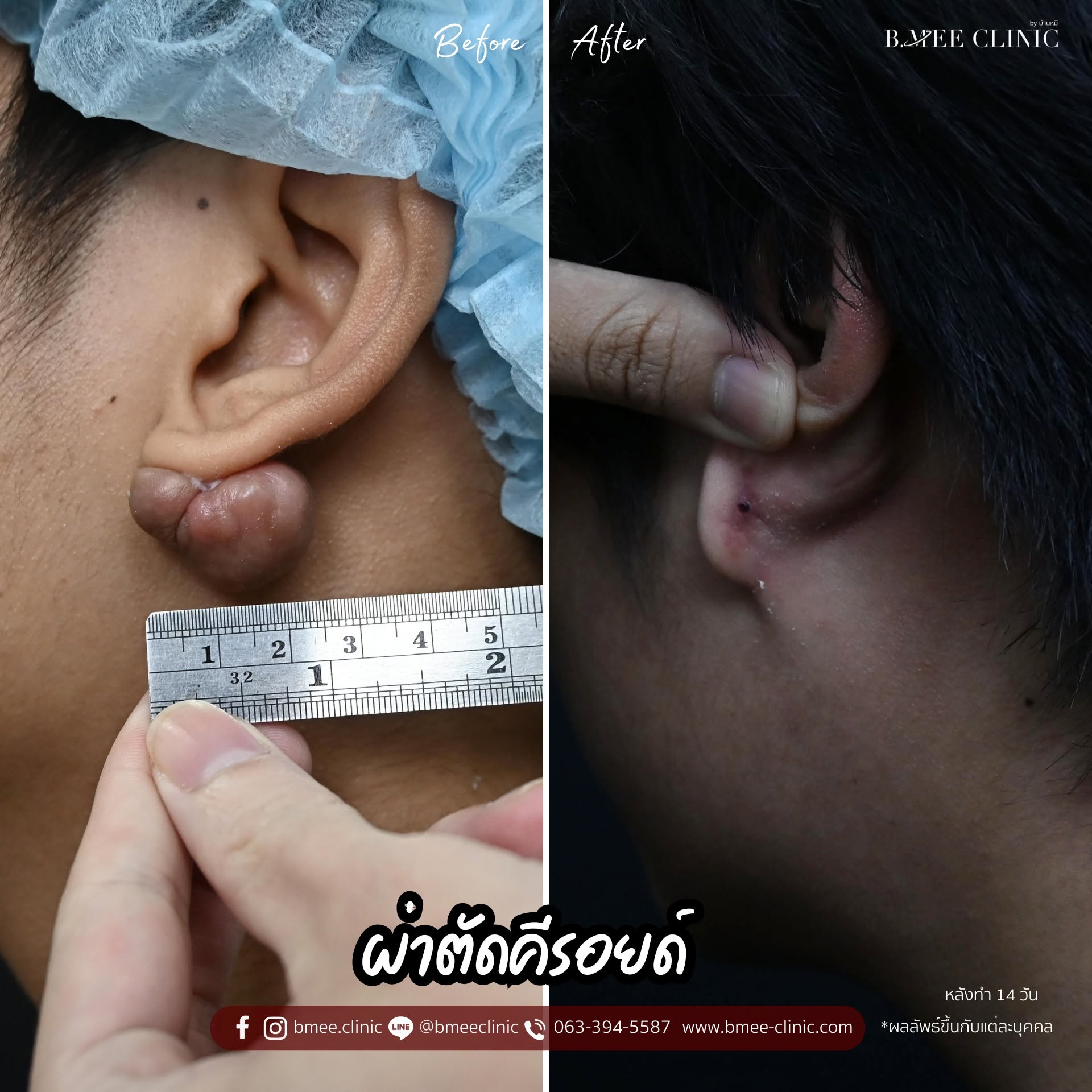 รีวิวศัลยกรรมคีลอยด์ ก่อนและหลังทำ 14 วัน บ้านหมี คลินิก