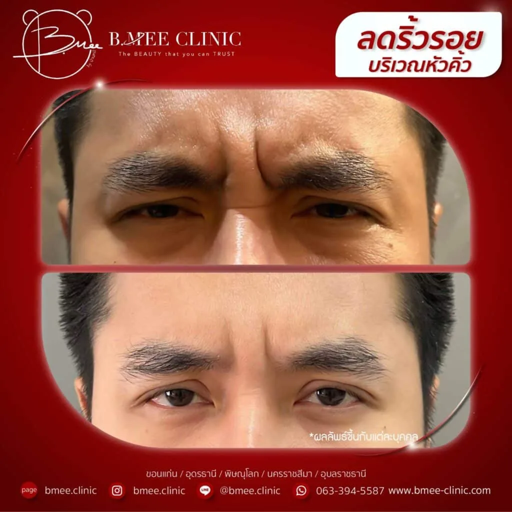 ก่อนและหลังฉีดลดริ้วรอยบริเวณหัวคิ้ว บ้านหมี คลินิก