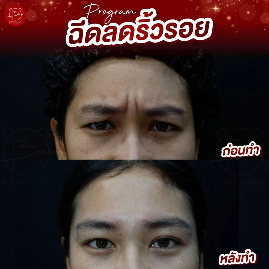 ก่อนและหลังฉีดโปรแกรมลดริ้วรอย บ้านหมี คลินิก
